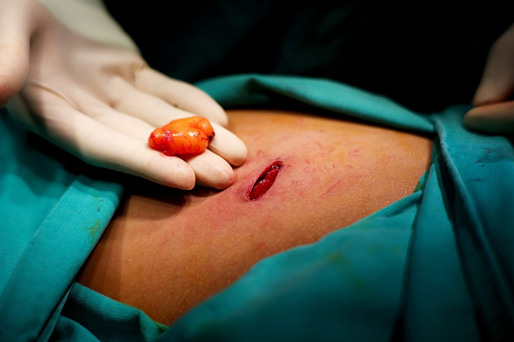 Lipoma treatment 1