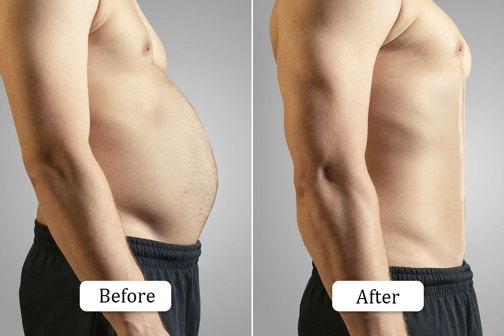 Liposuction