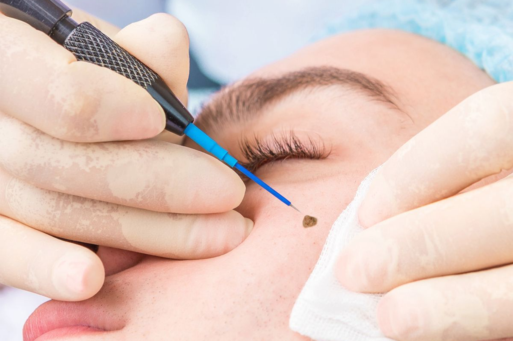 Mole remove
