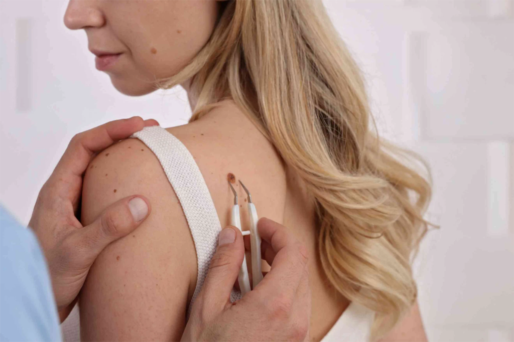 Skin tags remove 1
