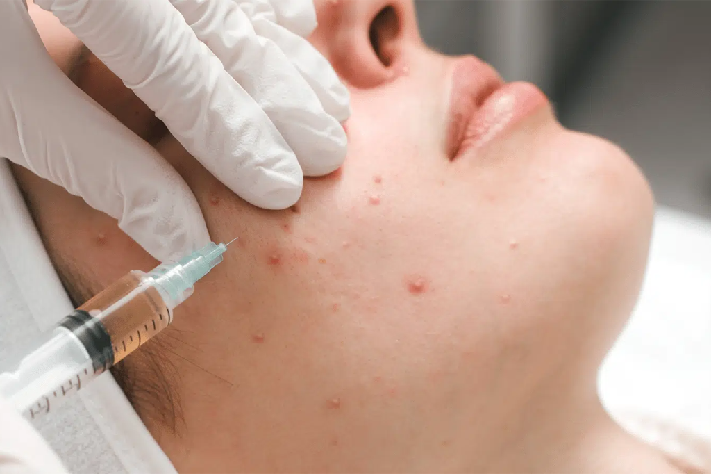 subcision treatment for acne 1